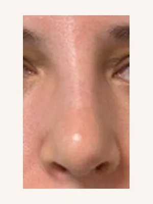 3 months after primary rhinoplasty frontal view