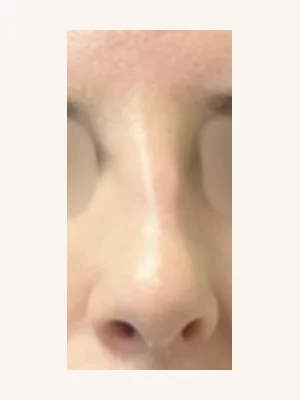Before primary rhinoplasty frontal view
