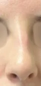 Before primary rhinoplasty frontal view