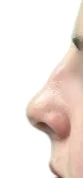 Before primary rhinoplasty profile view