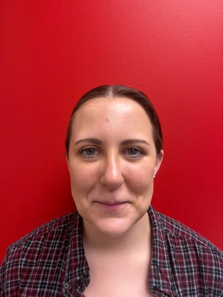 3 months after rhinoplasty front view