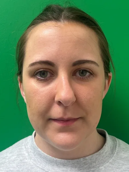 Before rhinoplasty front view