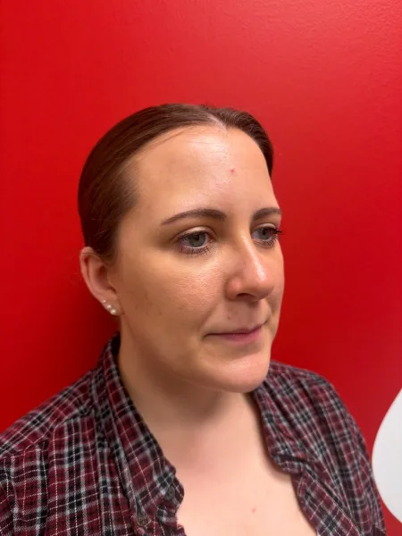 3 months after rhinoplasty oblique view