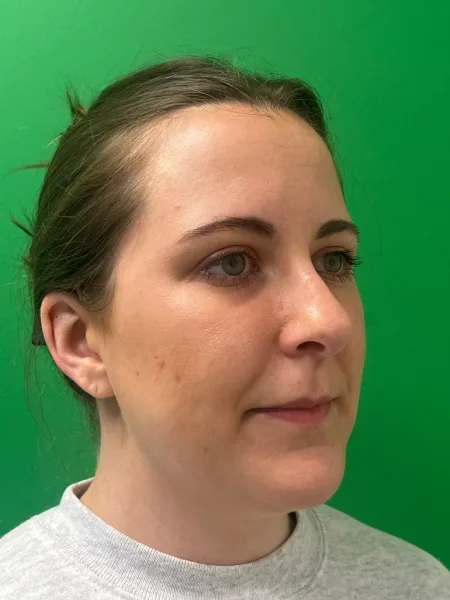 Before rhinoplasty oblique view