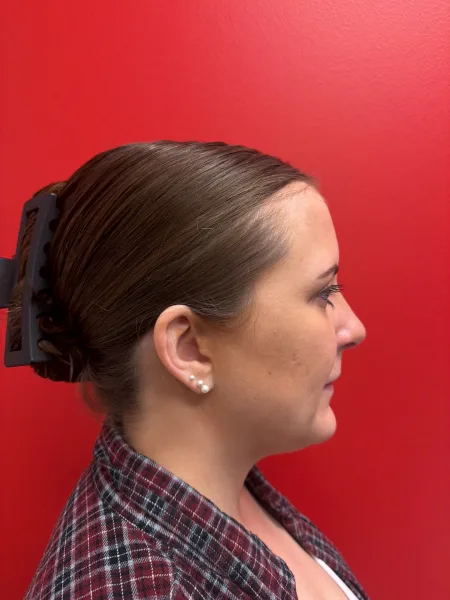 3 months after rhinoplasty profile view