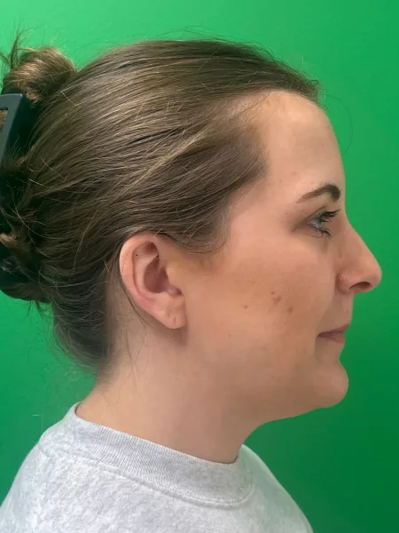 Before rhinoplasty profile view