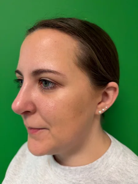 1 month after rhinoplasty left oblique view