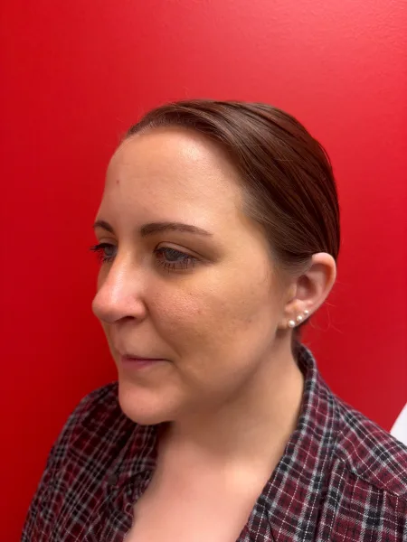 3 months after rhinoplasty left oblique view