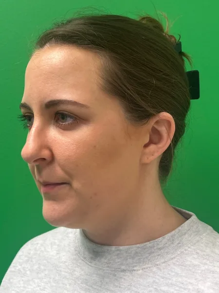 Before rhinoplasty left oblique view