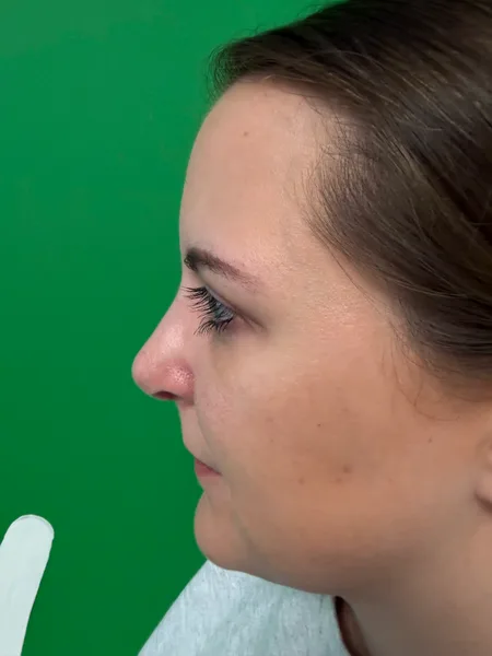 1 month after rhinoplasty left profile view
