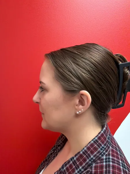 3 months after rhinoplasty left profile view