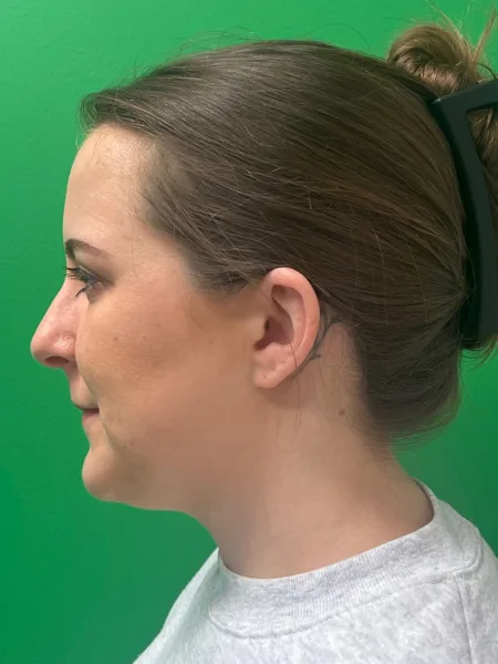 Before rhinoplasty left profile view