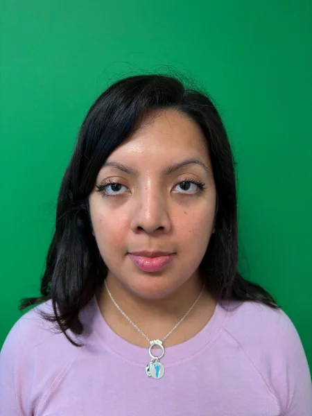 6 months after rhinoplasty front view