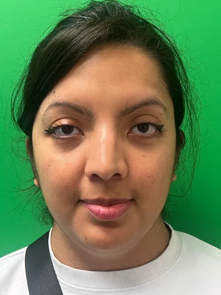 Before rhinoplasty front view