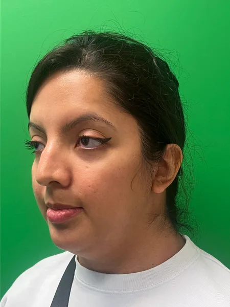 Before rhinoplasty oblique view