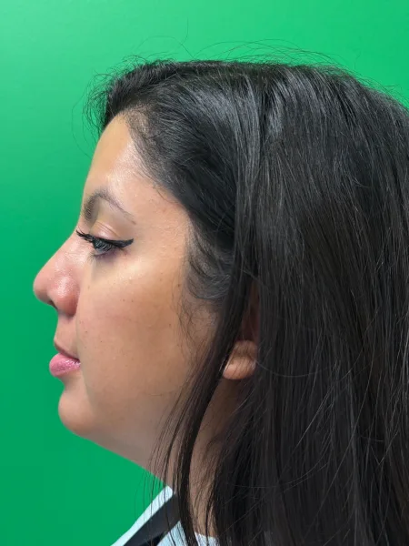 Left Profile 1 month after rhinoplasty