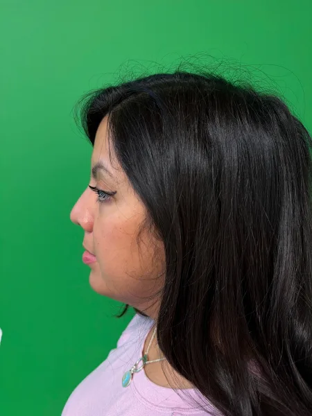 Left Profile 6 months after rhinoplasty