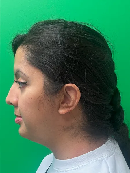 Left Profile before rhinoplasty