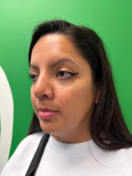 Right Oblique 1 month after rhinoplasty