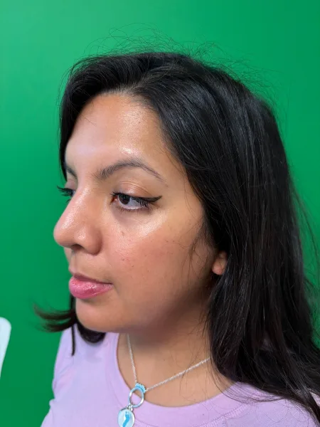 Right Oblique 6 months after rhinoplasty