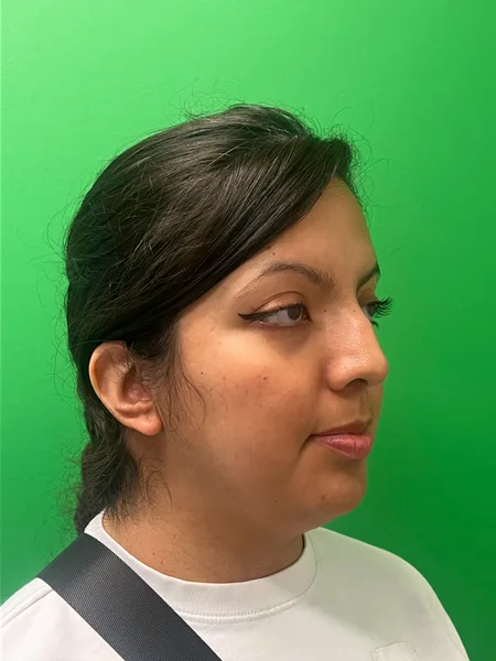 Right Oblique before rhinoplasty