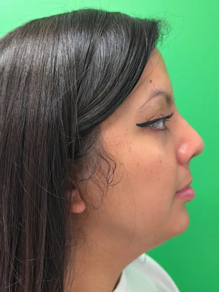 Right Profile 1 month after rhinoplasty