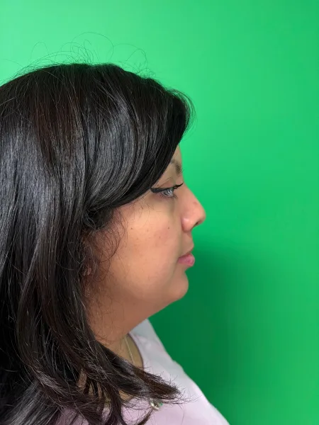 Right Profile 6 months after rhinoplasty
