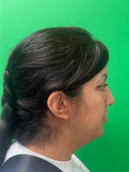 Right Profile before rhinoplasty