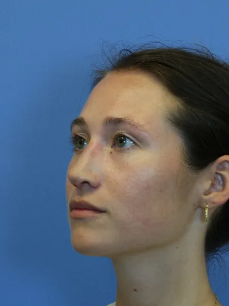 1 month after rhinoplasty left oblique