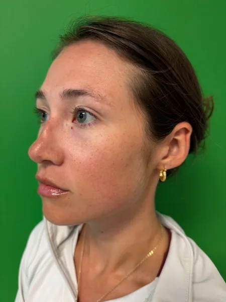Before rhinoplasty left oblique
