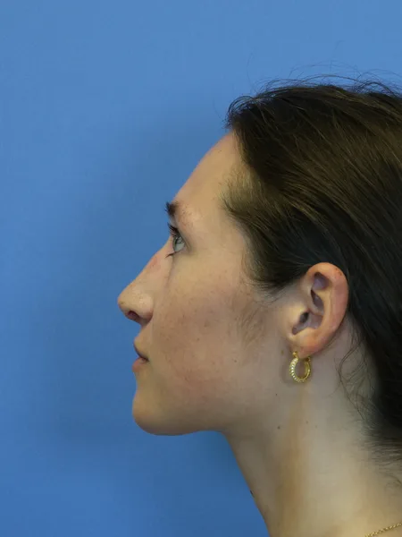 1 month after rhinoplasty left profile