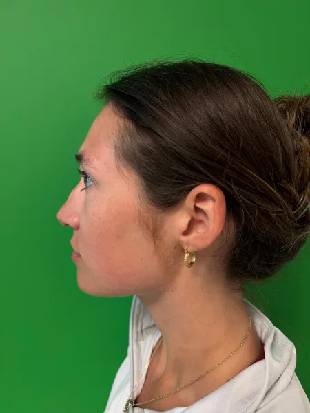 Before rhinoplasty left profile