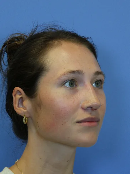 1 month after rhinoplasty right oblique