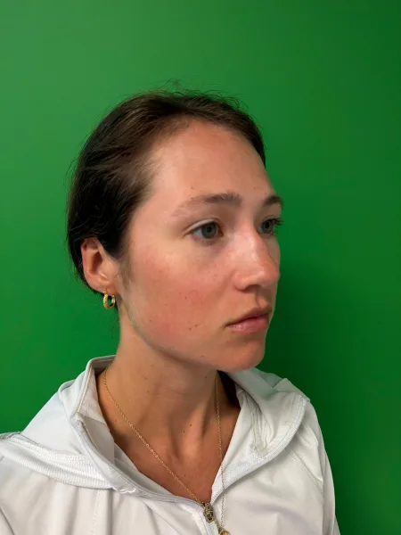Before rhinoplasty right oblique