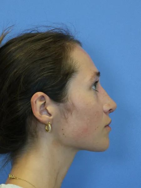1 month after rhinoplasty right profile