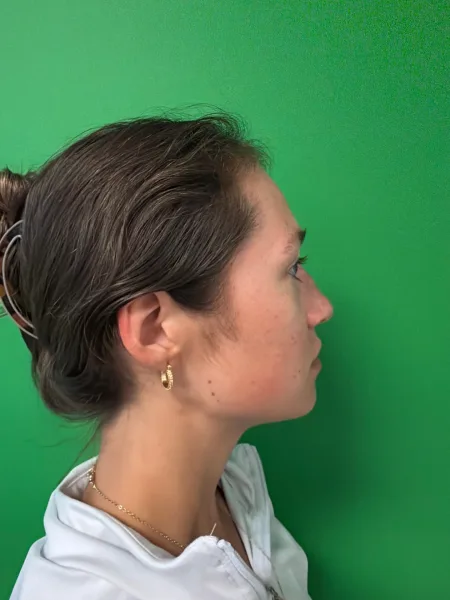 Before rhinoplasty right profile