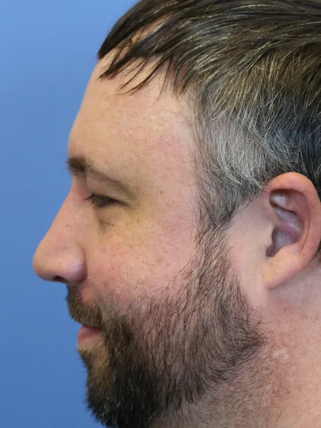 6 months after rhinoplasty left profile