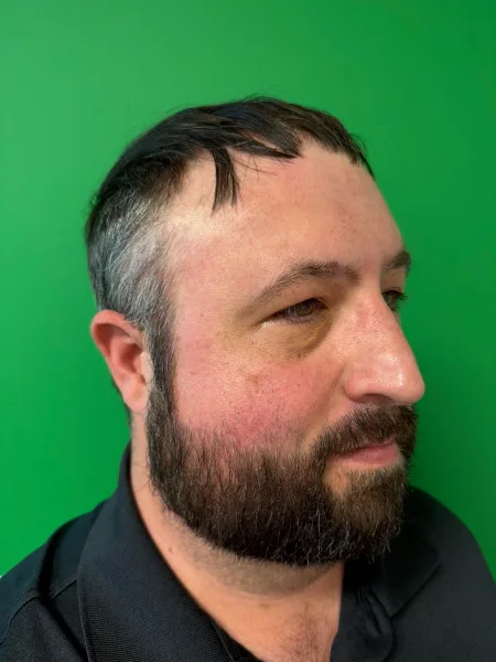 Before rhinoplasty right oblique