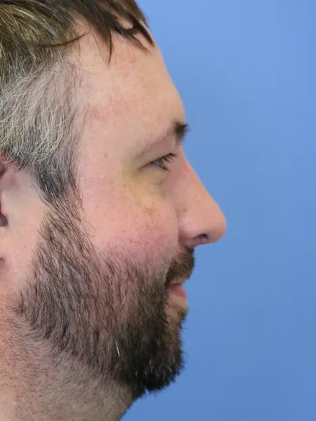 6 months after rhinoplasty right profile