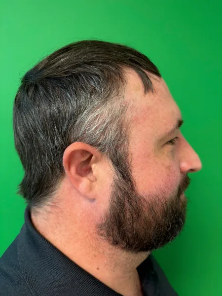 Before rhinoplasty right profile