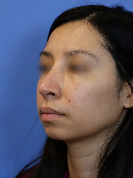 3 months after rhinoplasty left oblique