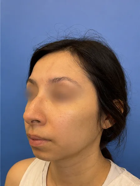 Before rhinoplasty left oblique