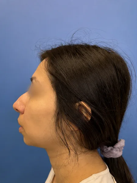 Before rhinoplasty left profile view