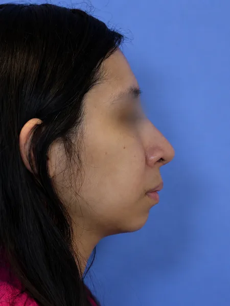 3 months after rhinoplasty right profile
