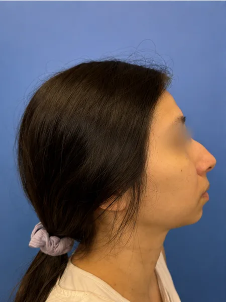 Before rhinoplasty right profile